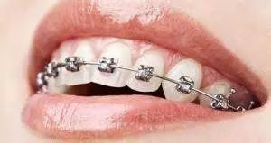 牙齿矫正戴牙套大揭秘,成年人牙齿矫正怎么避免牙套脸