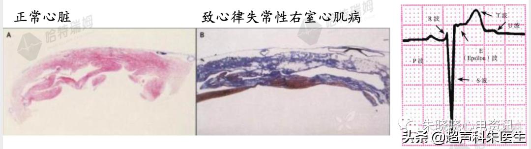 t波倒置诊断,t波倒置如何区分严重程度