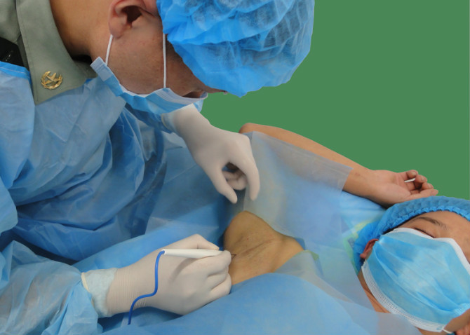 可视微创腋臭手术哪个医院好,宁波微创腋臭手术哪家好