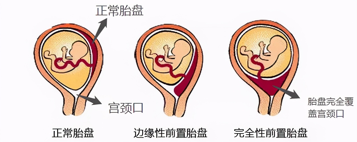 凶险性前置胎盘剖宫产前沿信息,凶险性胎盘穿透式胎盘植入