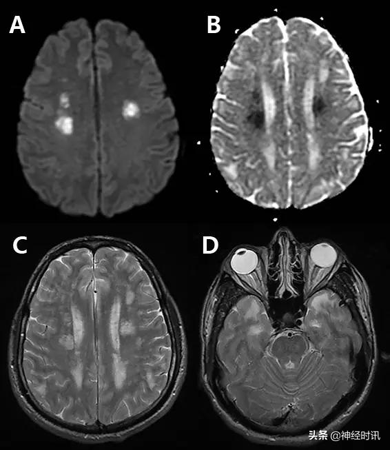 脑卒中的快速识别ppt,脑卒中神经影像学实例解析