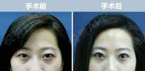 面部衰老改善最好的方法,衰老与面部轮廓的变化