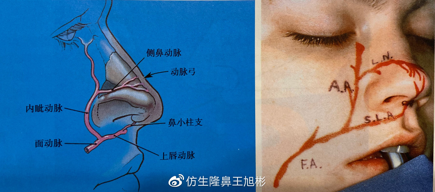 假体隆鼻的危害和后遗症,隆鼻整形麻醉你能坚持多长时间