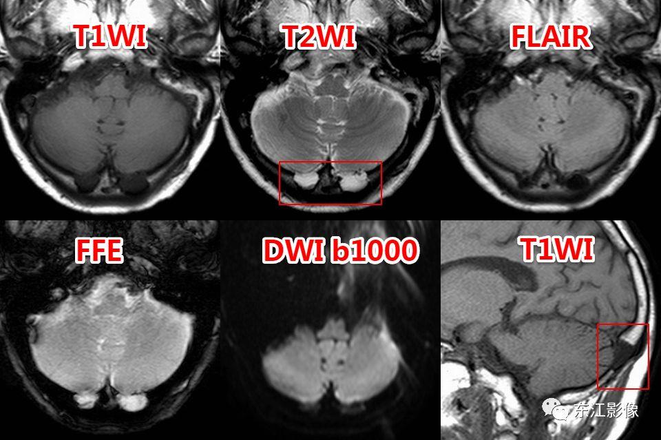 头颅mri扫描影像哪里找,头颅影像mra详细解说