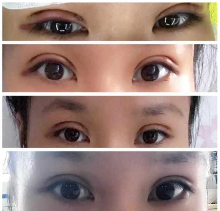 割双眼皮到底有多痛,两分钟让你了解美睫