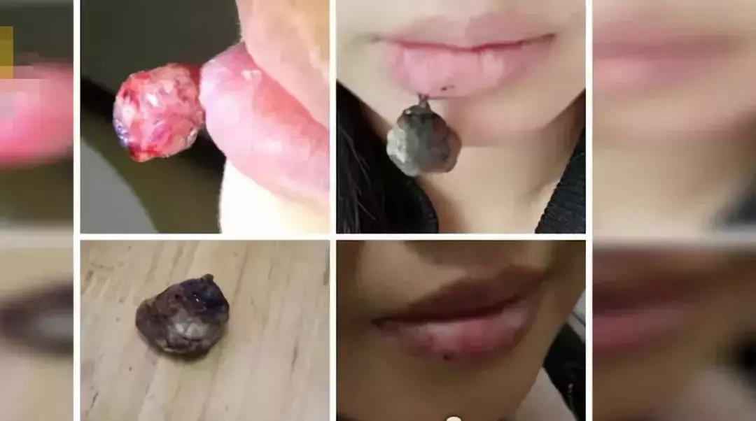 怀孕晚期嘴唇上得了血管瘤怎么办,孕妇嘴唇长血管瘤怎么办