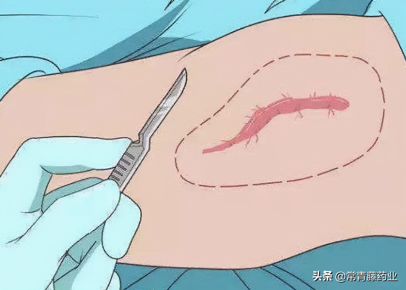 爱美之心,人皆有之,瘢痕的这些事是你想要知道的吗?