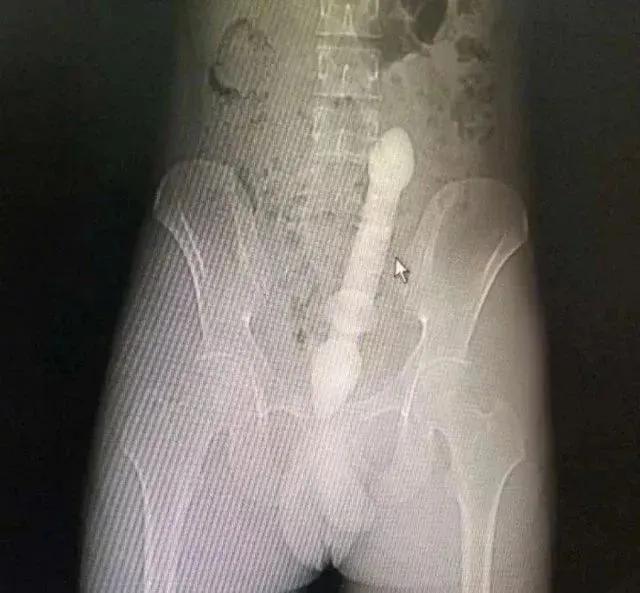 科普直肠息肉,直肠生理弯曲