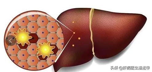 门静脉高压引起的肝硬化怎么治疗,肝硬化门静脉高压吃中药能缓解吗