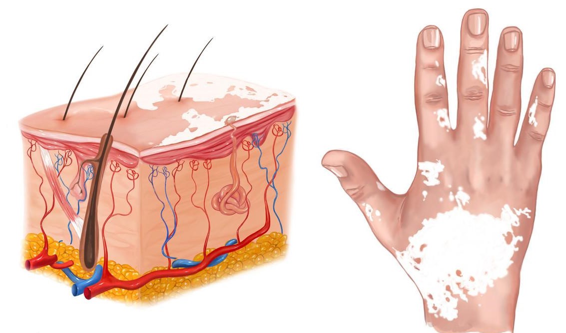 白癜风多大年龄并发症就出来了,白癜风伴随着哪几种常见并发症
