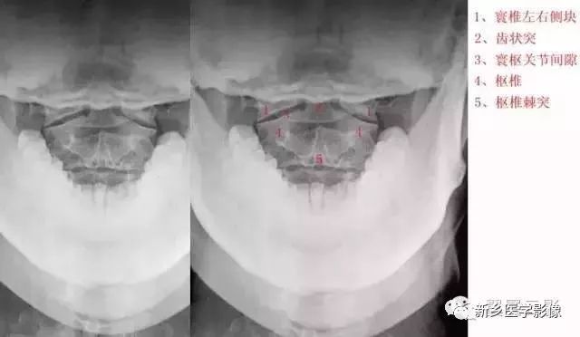 肘关节x线解剖,颈椎x线图片与讲解大全
