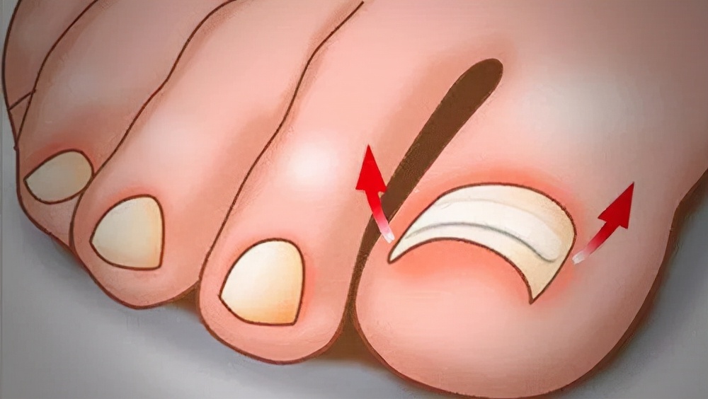 脚趾甲长肉里疼的实在受不了了,脚趾甲长到肉里只需一招轻松解决