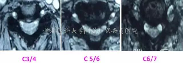 颈椎病引起的胸闷胸痛在哪个部位,颈椎病会引起咳嗽胸闷胸痛吗