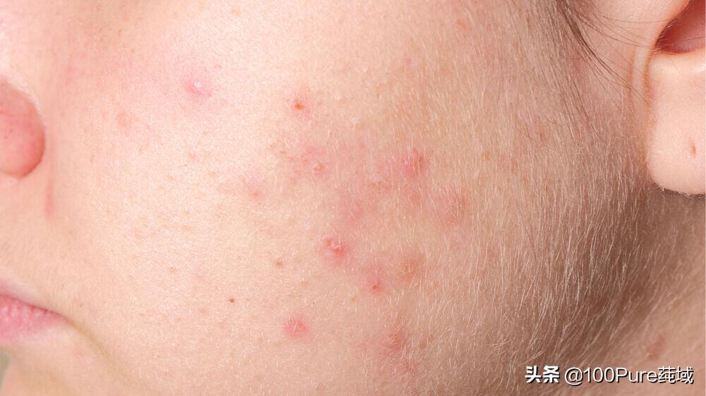 因为出油长痘该怎么改善,皮肤出油长痘用什么护肤品好