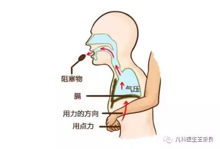 异物卡喉快用海姆立克法抢救,异物卡喉海姆立克急救方法