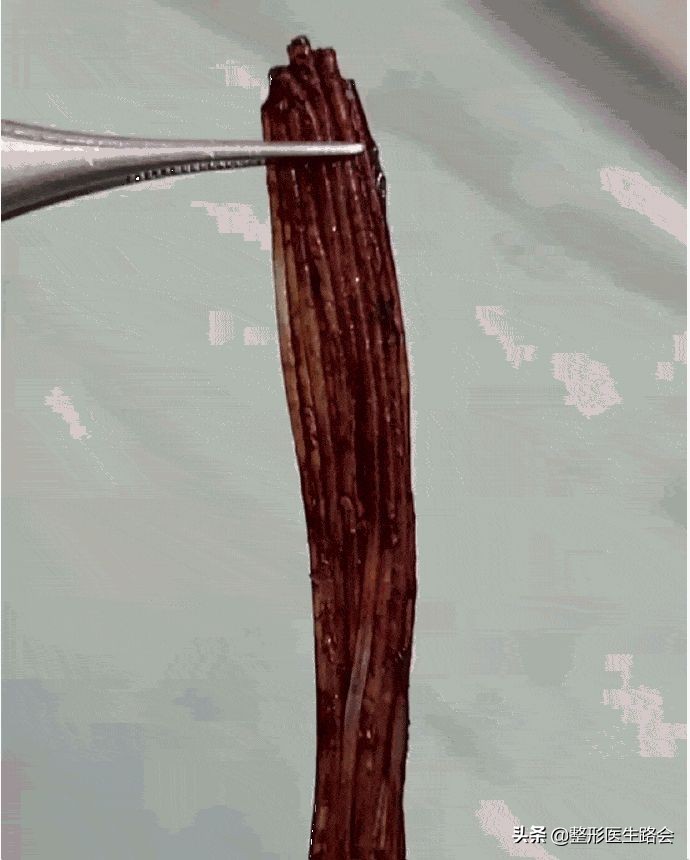 线雕隆鼻和软骨隆鼻哪个好,线雕隆鼻跟假体隆鼻哪个好看