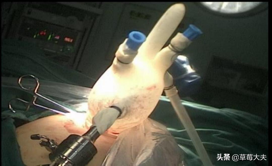 「人气案例」宫颈癌手术就得终生挂尿袋生活？草莓医院专家SayNo