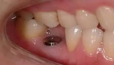 牙缝越来越大是什么导致的,牙缝越来越大什么病中医怎么说