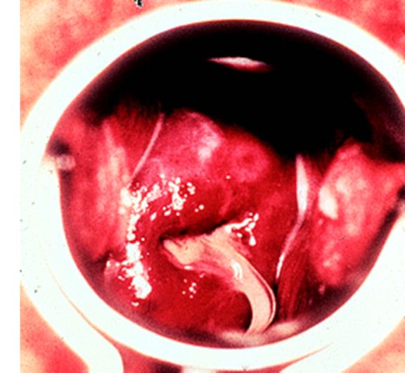 为什么得了宫颈炎没有症状,得了慢性宫颈炎不来月经怎么办