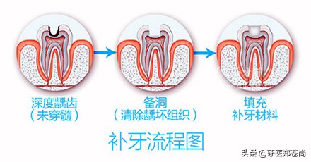 蛀牙严重到什么程度需要根管治疗,7岁小孩蛀牙很严重要怎么治