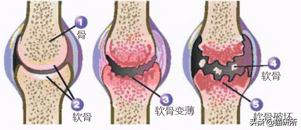 软骨素对膝盖疼有帮助吗,软骨素对全身疼痛有用吗