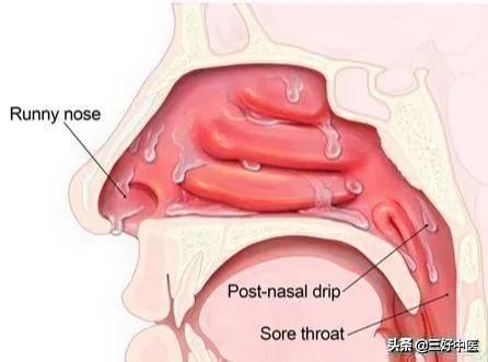 近期儿童咳嗽怎么治最快最有效,孩子咳嗽又犯了教你一招定位止咳