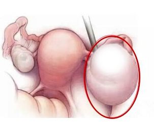 腺肌症+巧囊,这一路实在太难,后来才知道这俩可以一起解决