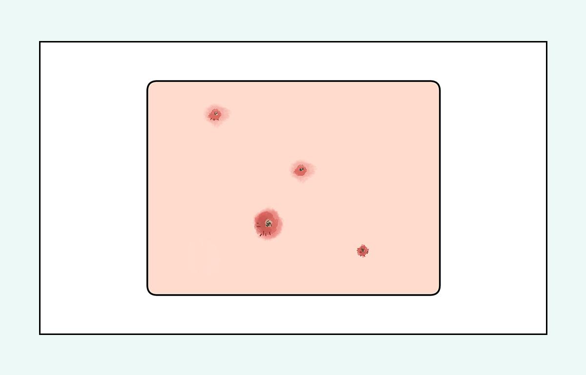 脸上的红疙瘩怎么彻底消除,脸上红疙瘩的种类