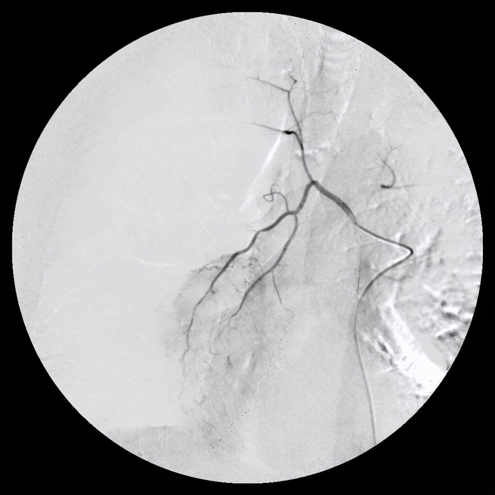 80岁得癌症放弃治疗,80岁以上肺癌建议手术吗