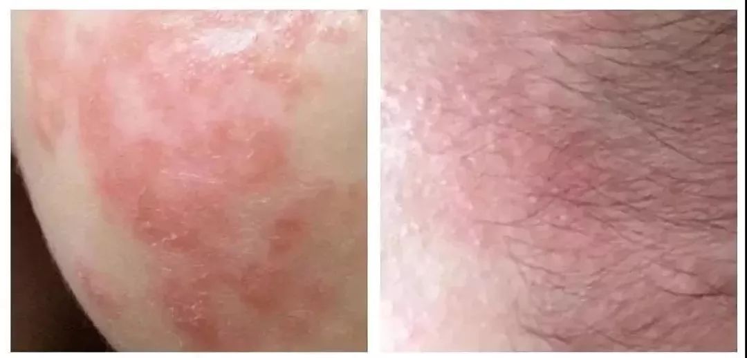 宝宝冬季起痱子怎么处理,宝宝冬天起热痱子最有效的方法