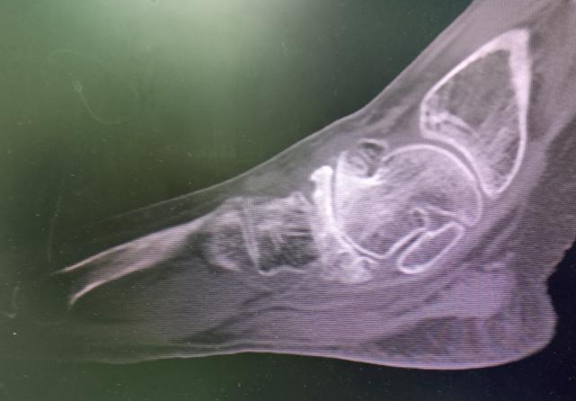 21岁得股骨头坏死前期能修复好吗,女性得股骨头坏死病的多吗