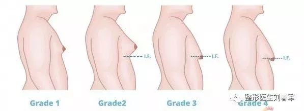 男性胸发育了怎么办,男性胸部发育了怎么办