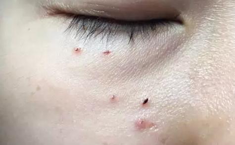 脂肪粒去粒神器 (日本自动消除脂肪粒)