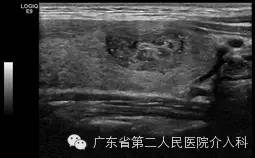 甲状腺良性腺瘤做消融好吗,甲状腺囊性腺瘤用做手术吗