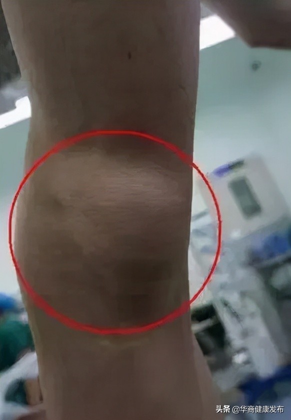 脚膝盖腘窝囊肿手术要注意什么,腘窝囊肿关节镜切除
