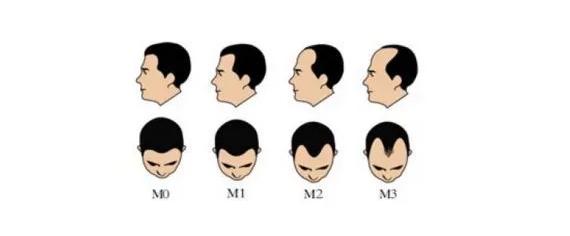 脱发的原因有哪些快点进来看看吧,出现这两种脱发别慌一招帮您搞定