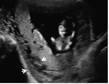 临床上最常见的异常胎盘,前置胎盘和低置胎盘超声