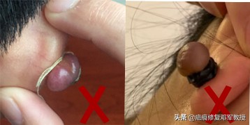 耳朵上的瘢痕疙瘩可以用线勒掉吗,耳朵疤痕疙瘩手术多少钱