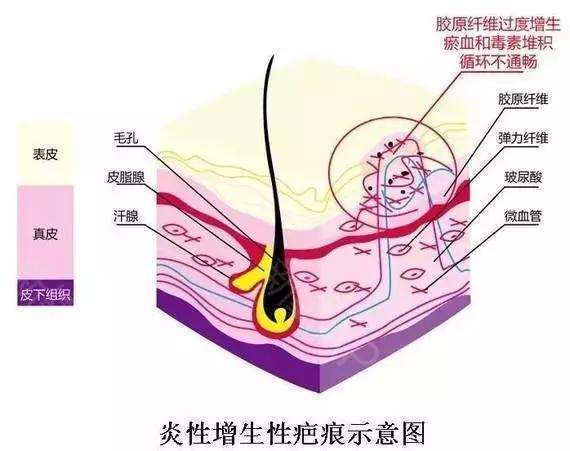 肛肠外科手术伤口护理,肛肠手术伤口换药用什么药好