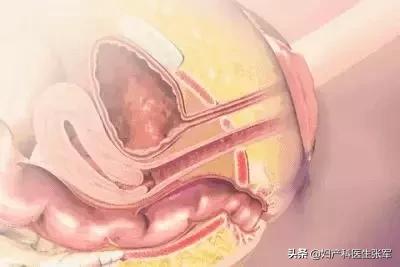 盆底裂了漏尿怎样做康复,盆底漏尿是什么原因造成的