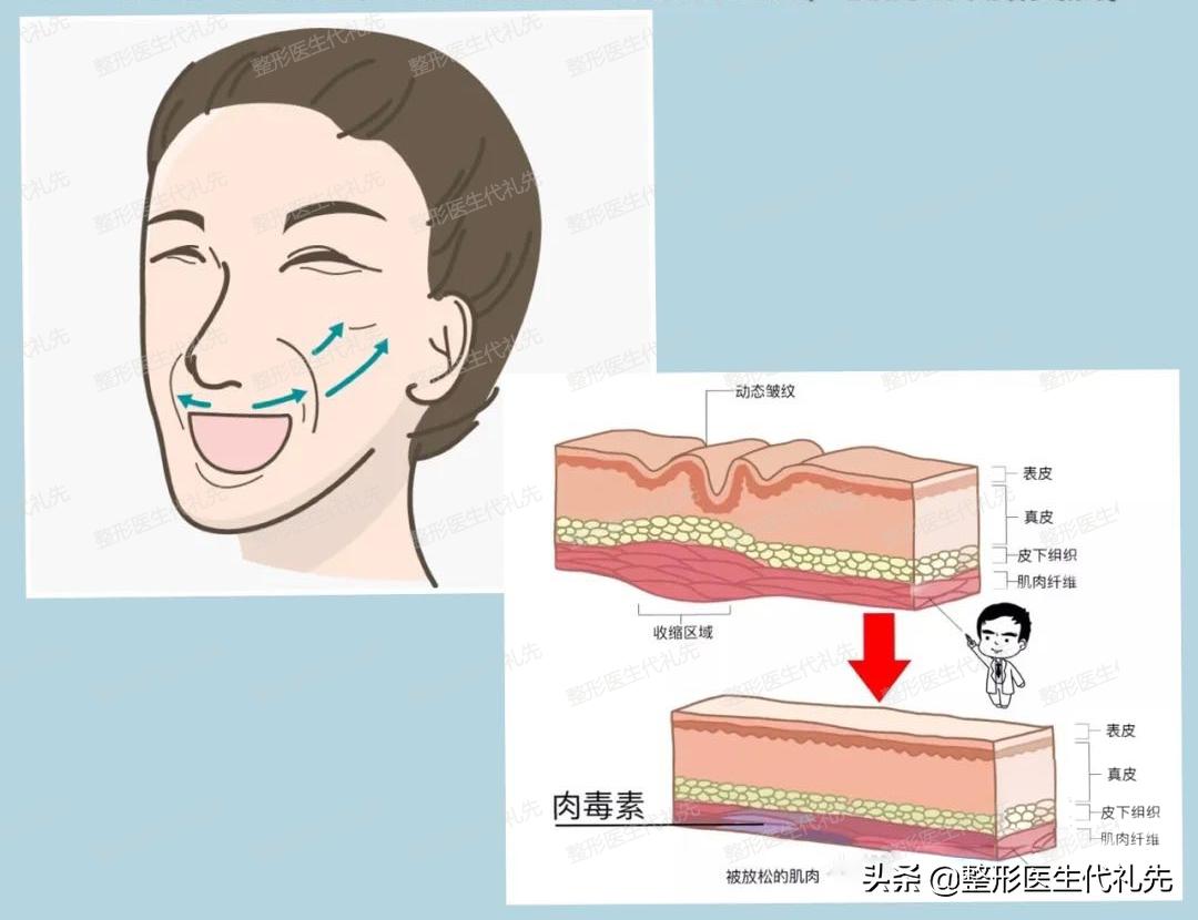 从医学来讲法令纹怎么改善比较好,整形医生怎么解决法令纹的问题