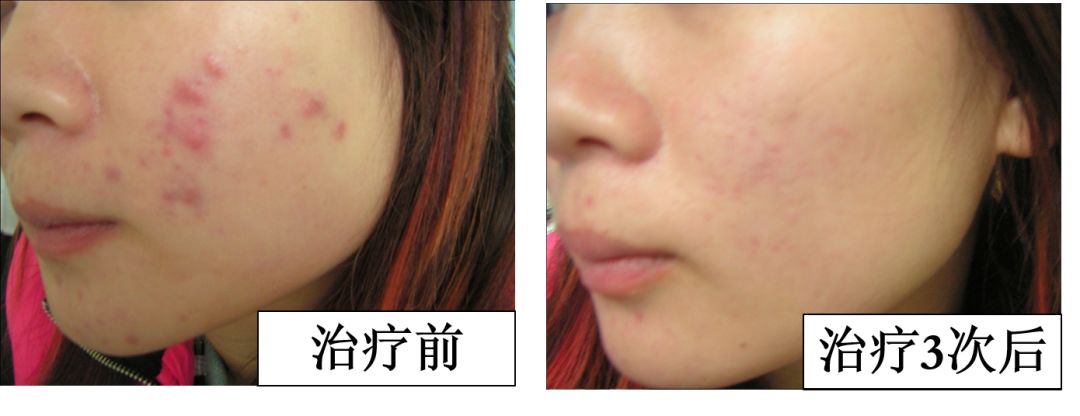 中医火针疗法教学视频,火针操作手法