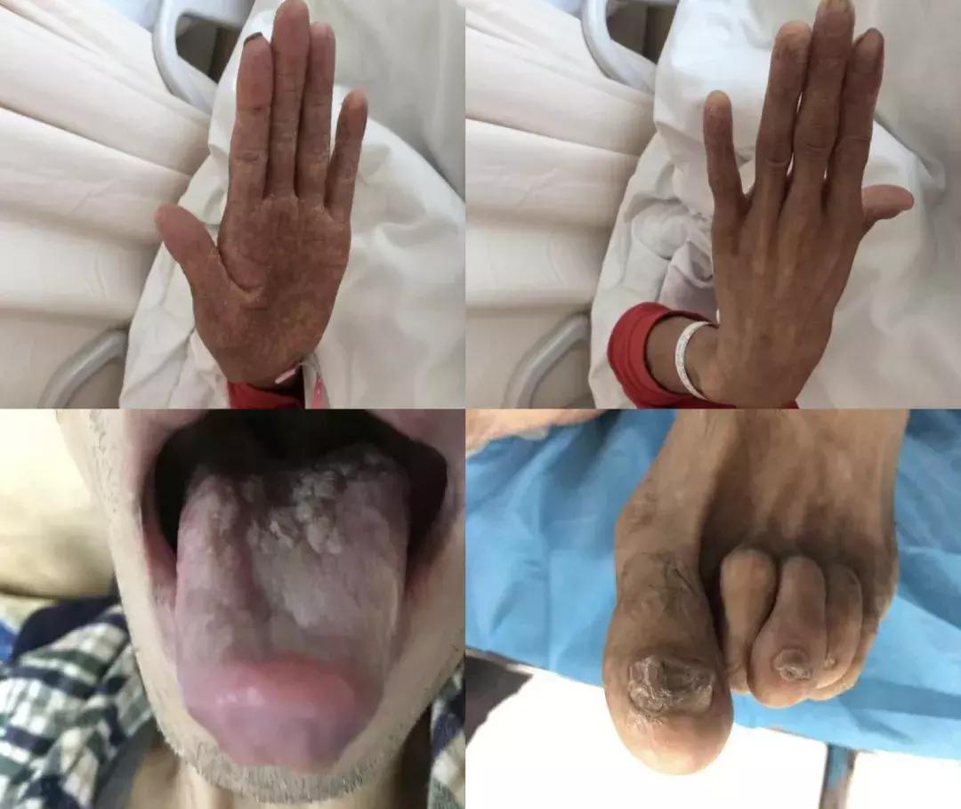 肺纤维化病例,肺纤维化手指甲发紫还能活多久