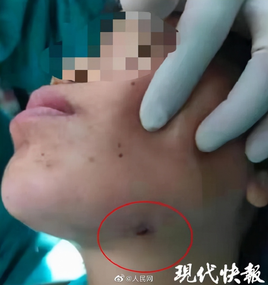 女子智齿反复发炎脸颊,智齿反复发炎脸上烂掉了