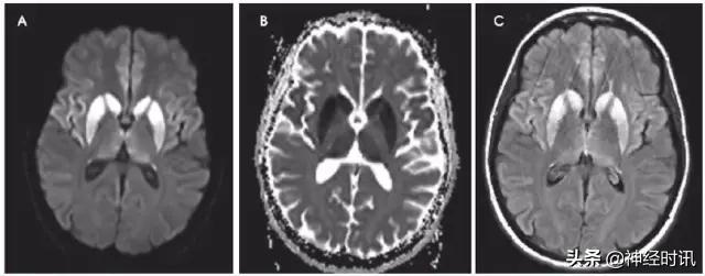 脑卒中病历诊断书图片,脑卒中影像判断技巧图解电子版