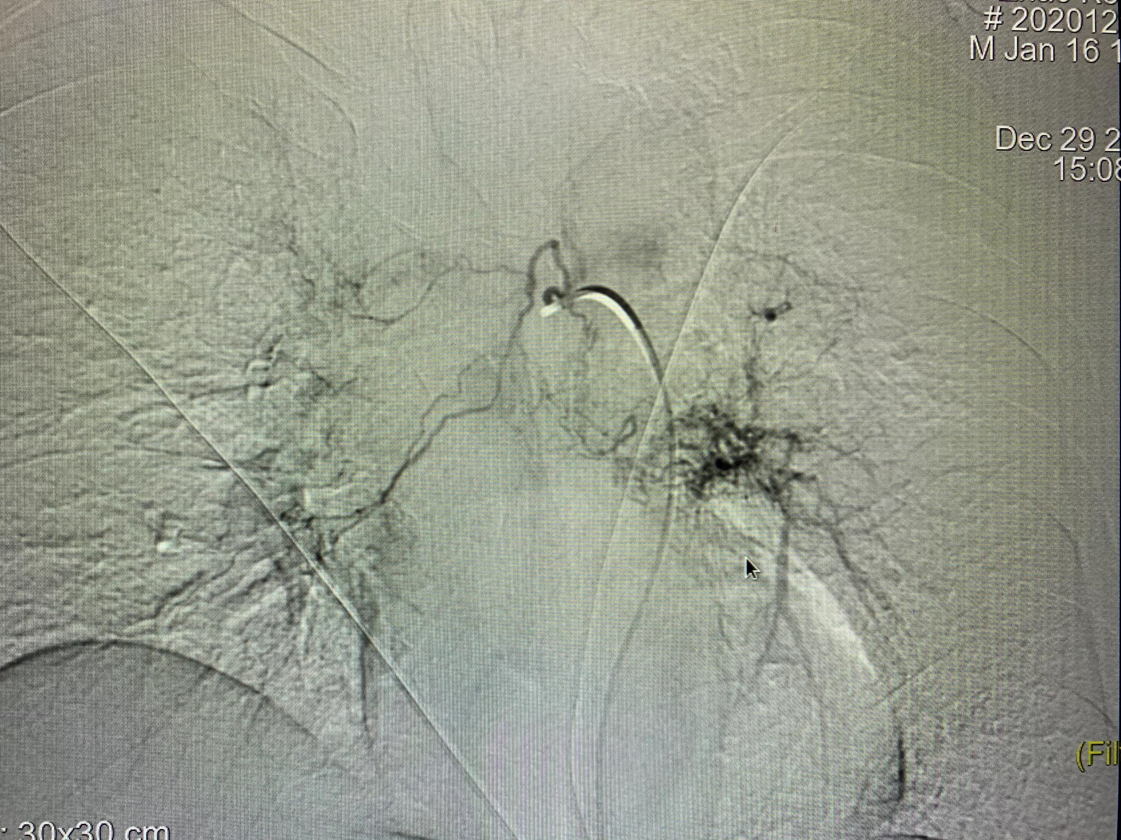 肺癌栓塞的介入治疗,84岁老人患肺癌可以做微创介入吗