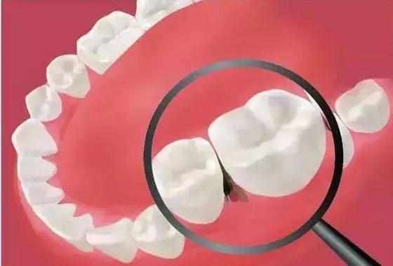 吃东西老塞牙，牙缝里有臭味！怎么办？