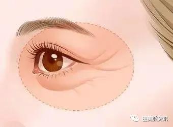 眼周除皱的最佳方法,眼周祛皱术后效果对比