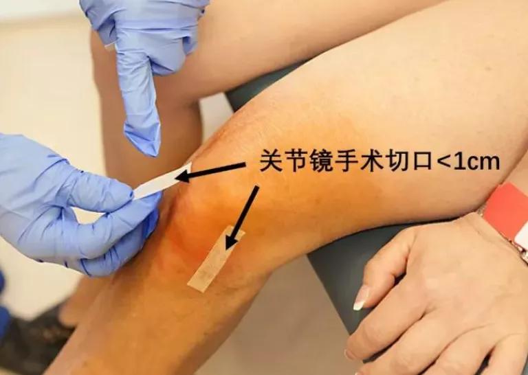 微创手术能治好骨性关节炎吗,膝盖关节镜微创手术要脱衣服吗