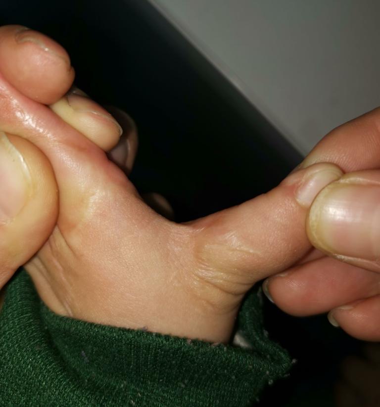 并指畸形免植皮案例,并指畸形